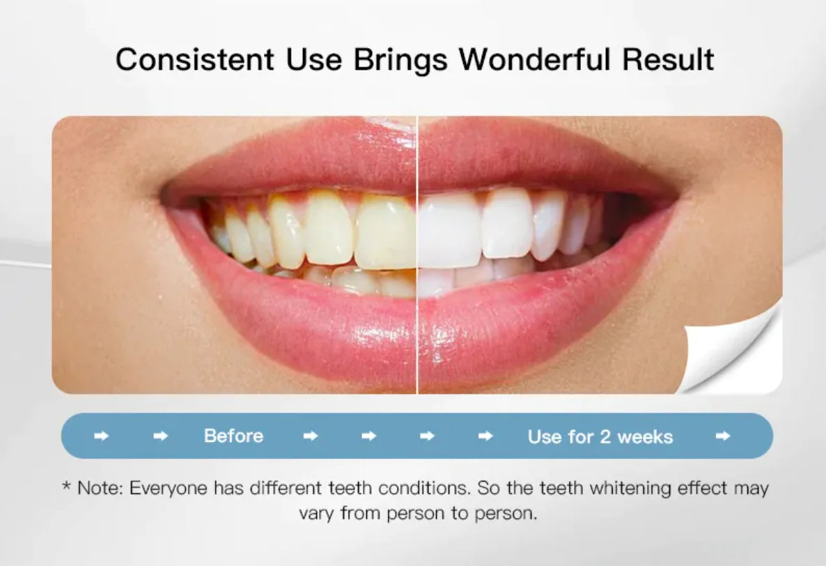 WeissMD Bleaching Kit